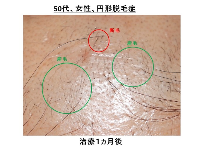 円形脱毛症　病院